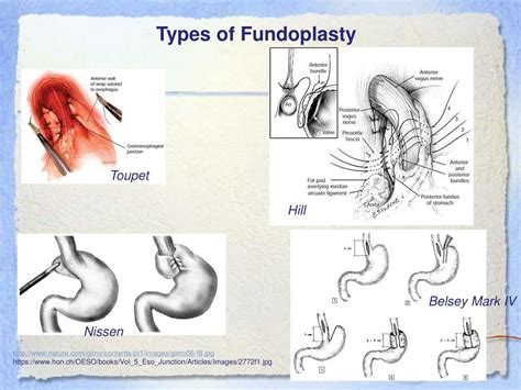 Ppt Esophagogastric Fundoplasty Powerpoint Presentation Free