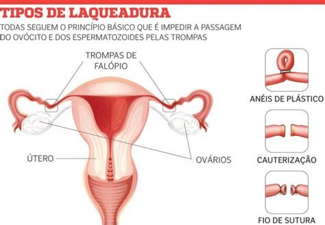 Cirurgia de Laqueadura pelo SUS 2023 Como Fazer Grátis