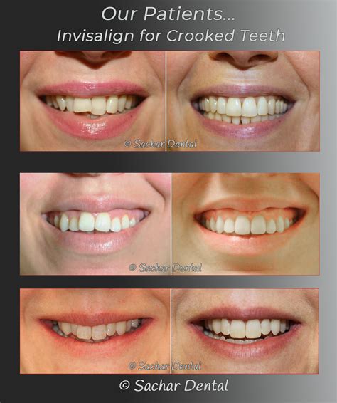 Dentist NYC Invisalign For Crooked Teeth Sachar Dental NYC