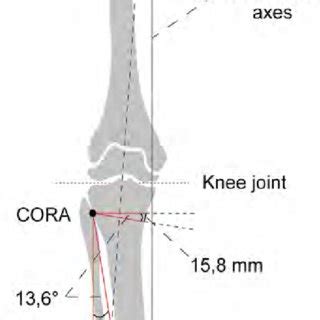 High Tibial Osteotomy With A Computer Assisted Navigation System From