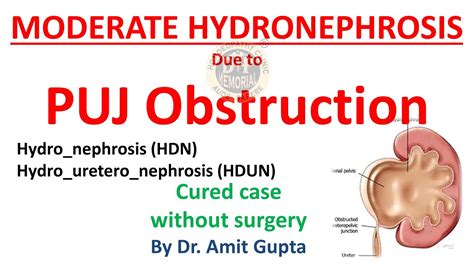 Puj Obstruction Moderate Hydronephrosis Cured Case Youtube