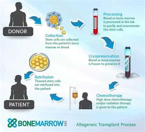 Allogeneic Stem Cell Transplantation | UAMS Stem Cell Transplantation ...