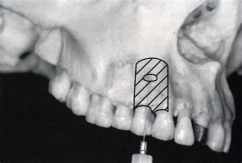 Maxillary Injection Techniques Flashcards Quizlet