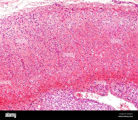 Waterhouse-Friderichsen syndrome, light micrograph Stock Photo - Alamy