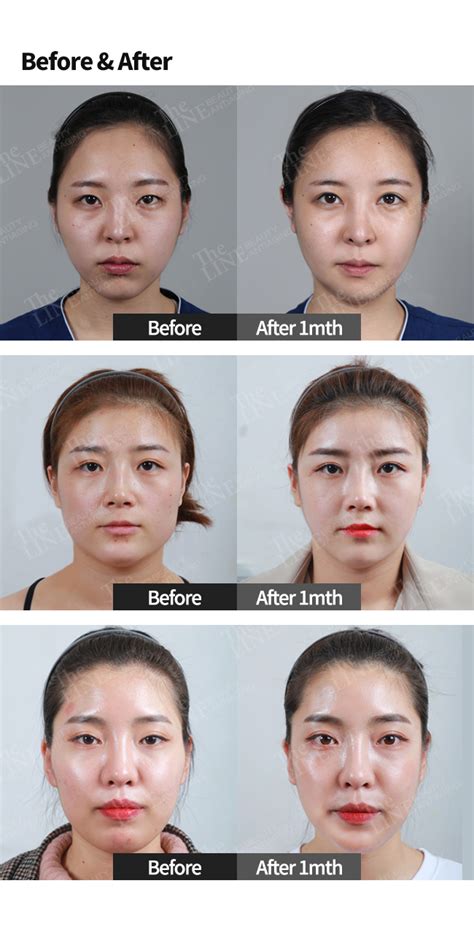 Asian Face Reconstructive Surgery Telegraph