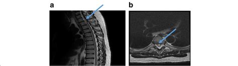 A Sagittal T2 Weighted Magnetic Resonance Imaging Mri Scan Through