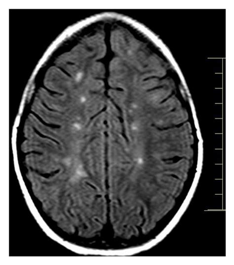 Brain Mri Showing Multiple Juxtacortical Lesions Download Scientific Diagram