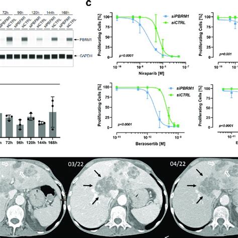 Vulnerability Of Pbrm Deficient Biliary Tract Cancer To Dna Damage