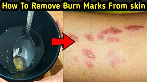 Best Home Remedy For Burn Marks From Skin How To Remove Burn