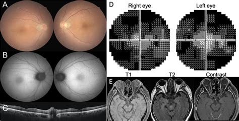 A Color Fundus Photography Shows Subtle Discoloration At The Posterior