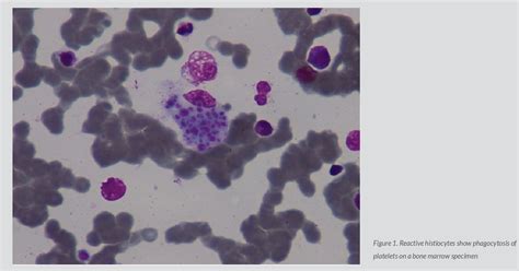 Figure 1 From Secondary Haemophagocytic Lymphohistiocytosis Syndrome