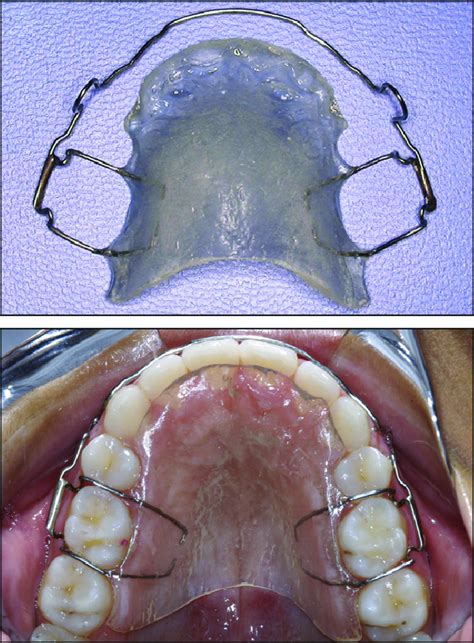 Modified Hawley Retainer Used By The Patients In Both Groups Download Scientific Diagram