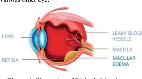 Figure 1 From Overview Of Risk Factors Of Diabetic Macular Edema