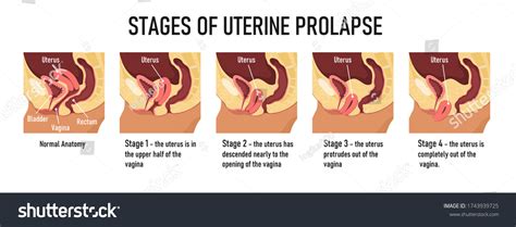 Stages Uterine Prolapse Vector Illustration Arkivvektor Royaltyfri