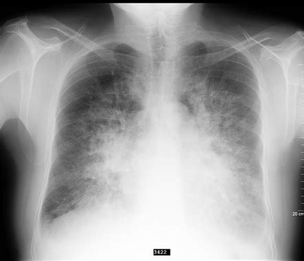 Pulmonary Oedema Radiology Reference Article Radiopaedia Org