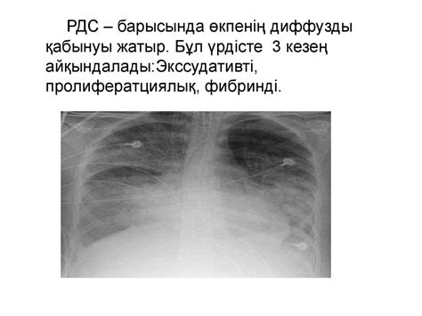 Респираторлы дистресс - синдромы - презентация онлайн
