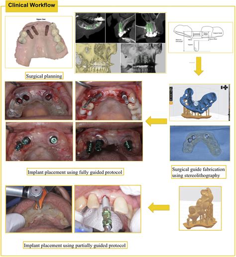 In Vivo Tooth Supported Implant Surgical Guides Fabricated With Desktop