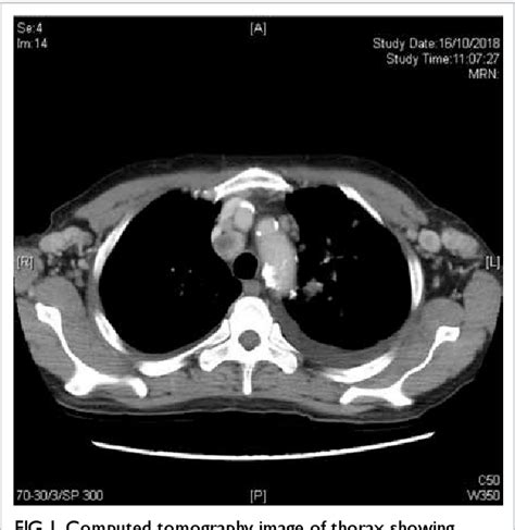 Figure 1 From Kaposis Sarcoma Presenting With Multiple Cervical