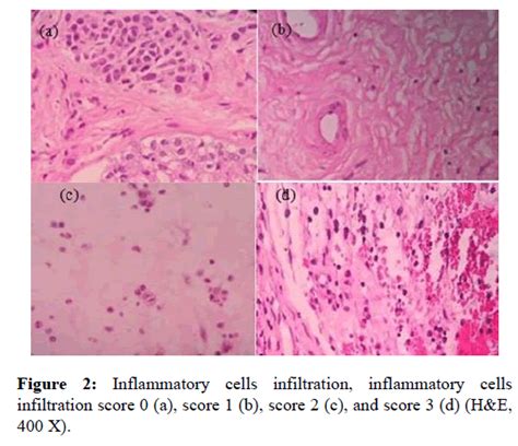 Expressions Of Eosinophil In Chronic Rhinosinusitis Patients With Nasal