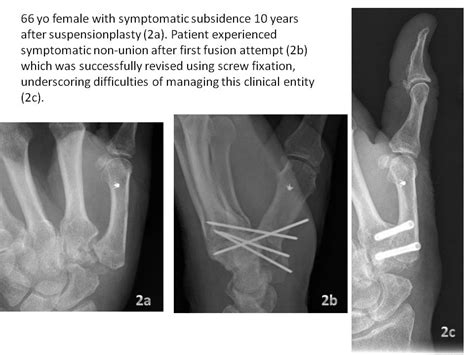 Aahs Outcomes Of Arthrodesis For Management Of Failed Basal Thumb