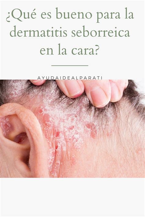 Qué es bueno para la dermatitis seborreica en la cara en 2020