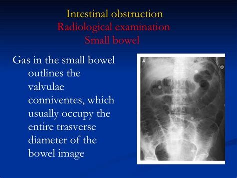 Intestinal Obstruction