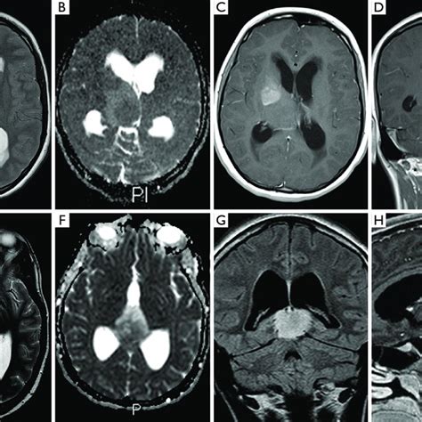 Variable Morphology Of H3 K27m Mutant Diffuse Midline Glioma Case 4