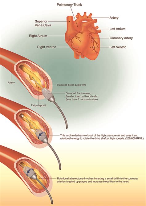 Atherectomy