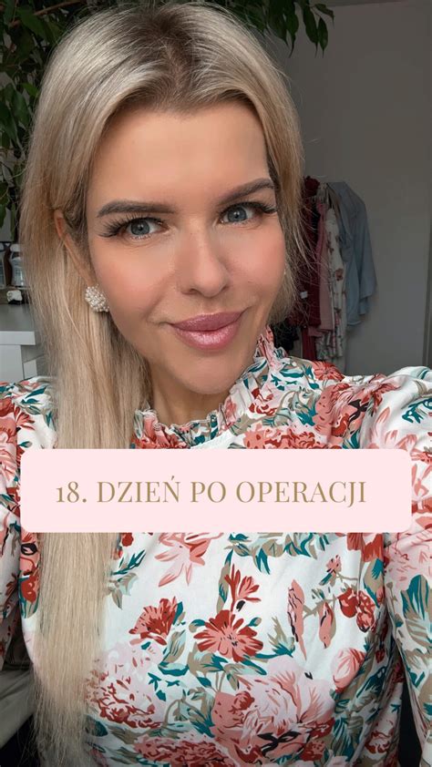 18 dzień po operacji Kasia Guzik