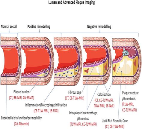 Molecular And Nonmolecular Magnetic Resonance Coronary And Carotid