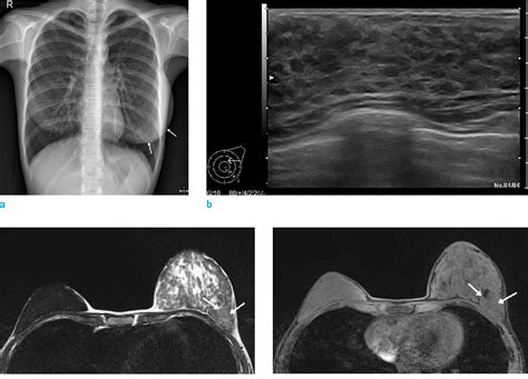 Bilateral Hypertrophy Of Breast