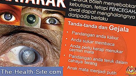 Katarak Kenali Gejala Dan Tanda Tanda Peringatan Ilmiah Praktis