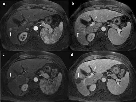 Lr5 Lesion In Segment 5 Treated With Tace Rfa A T1wi With Contrast Download Scientific