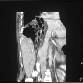 Three Dimensional CT Reconstruction Demonstrating The Diaphragmatic