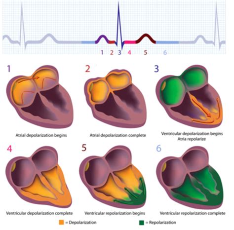 Dysrhythmias Ekg Flashcards Quizlet