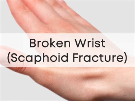 Scaphoid Fracture Treatment Surgery