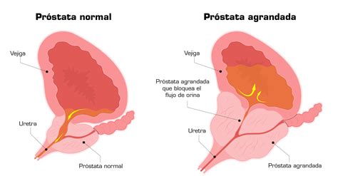 Cirug A De Hiperplasia Prost Tica Benigna Hpb Ems Urology