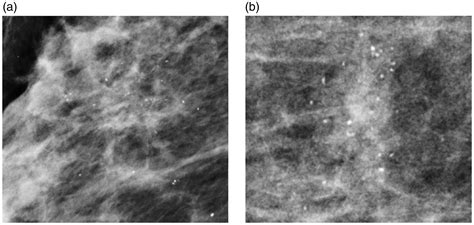 Simplifying Breast Imaging Reporting And Data System Classification Of Mammograms With Pure