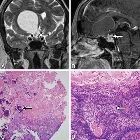 Primary Tumors Of The Pituitary Gland Radiologic Pathologic