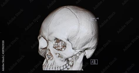 Ct Cine Scan Of A Patient Post Right Craniectomy With Encephalomalacic