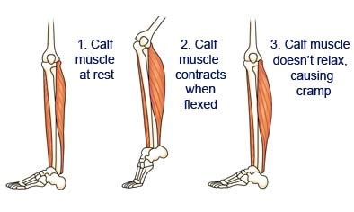 Leg Cramps - Causes and Prevention Tips | PatientsEngage