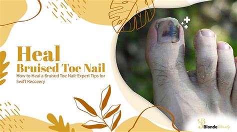 How To Heal A Bruised Toe Nail Expert Tips For Swift Recovery