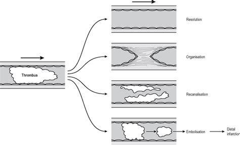 Thrombosis Embolism And Infarction Basicmedical Key