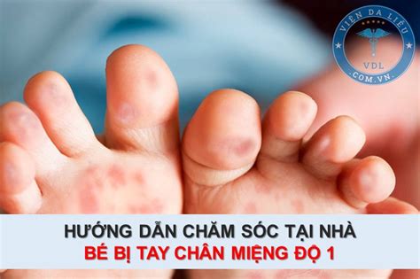 Hướng Dẫn Chăm Sóc Và điều Trị Tại Nhà Hiệu Quả Cho Bé Bị Tay Chân