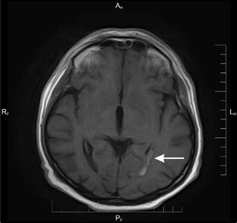 Axial T Weighted Scan After Contrast Enhancement Enhancing Lesion In