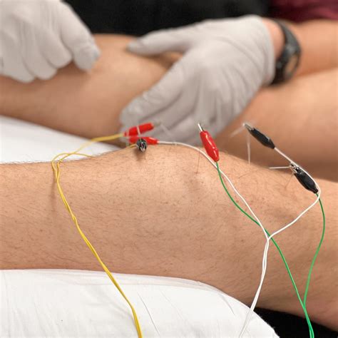 How Dry Needling Therapy Can Help Chronic Pain MS Physical Therapy