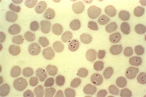 Free Picture Ultrastructural Morphology Exhibited Ring Form Plasmodium Falciparum Malaria