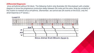 Ecg Conduction Abnormalities Ppt