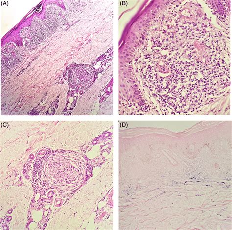 A Superficial Dermis Shows Lichenoid Granulomatous Infiltrate With