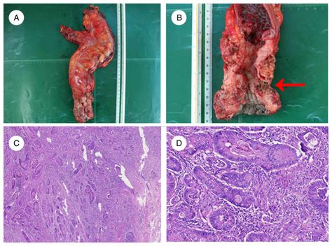 Fourniers Gangrene Due To Rectal Cancer A Case Report